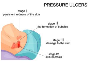 Examine the management of pressure ulcers in elderly patients